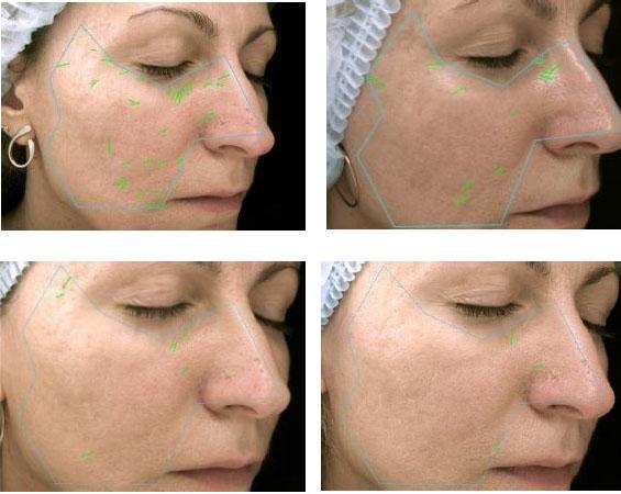 Технология омоложения фибробластами