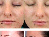 Технология проведения азелаинового пилинга