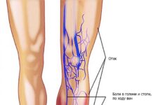 Тромбофлебит