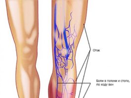 Тромбофлебит