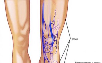 Тромбофлебит