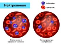 Диагностика и лечение фебрильной нейтропении