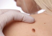 В чем опасность родинки?