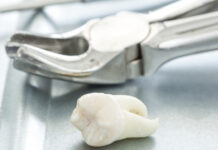 Безболезненное удаление зуба перед имплантацией — деликатно и не травматично