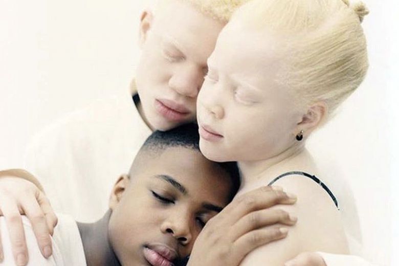 
Дети-альбиносы ведут борьбу за равенство всех людей, независимо от цвета кожи и расы                