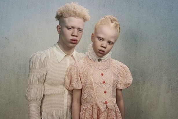 
Дети-альбиносы ведут борьбу за равенство всех людей, независимо от цвета кожи и расы                