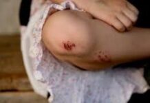 Коварные летние ссадины: дезинфицируем правильно, предотвращаем столбняк