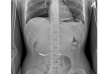 Зачем и как выполняется рентгенограмма брюшной полости