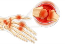 Симптомы и лечение ревматоидного артрита