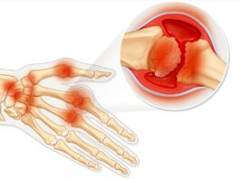 Симптомы и лечение ревматоидного артрита
