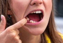 10 важных правил, которые нужно соблюдать пациентам после удаления зубов