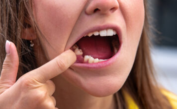 10 важных правил, которые нужно соблюдать пациентам после удаления зубов