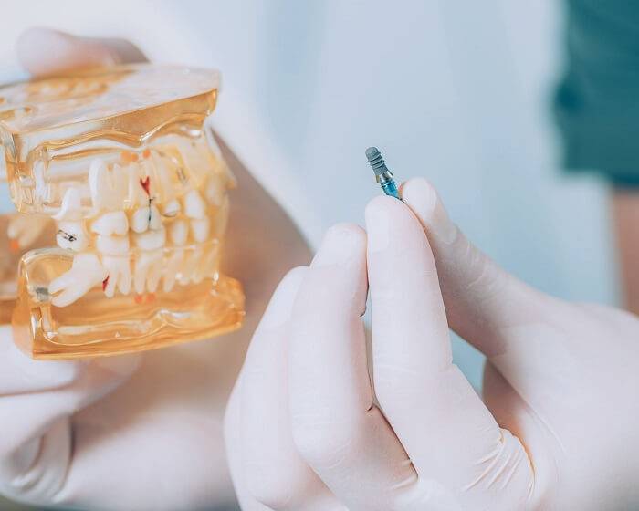 
Новое открытие: почему к 2030 году людям не нужно будет ставить импланты зубов                